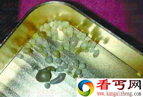 买生蚝吃出珍珠 细数那些吃出的意外之财（图）