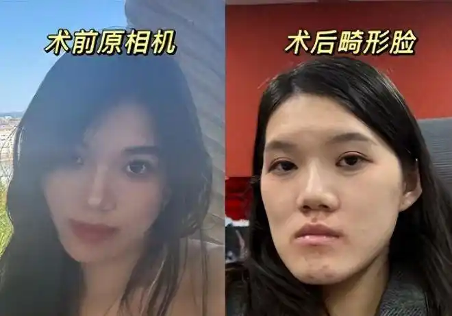 2毫米变13毫米！武大口腔医院正颌手术“