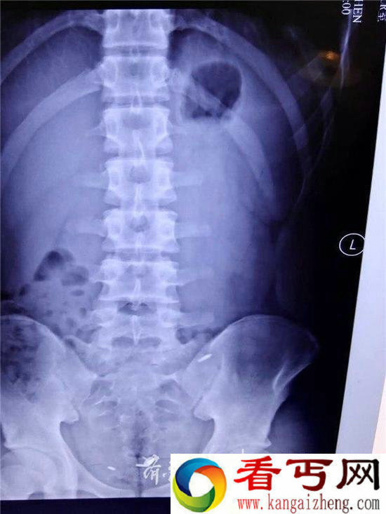 与同学打赌吞图钉 竟往自己肚脐眼插笔芯头