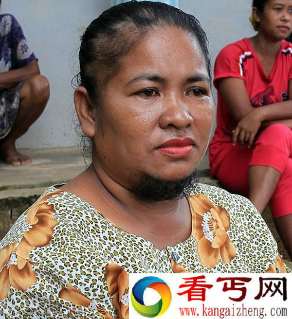女子生孩子后长胡子与胸毛 剪掉还会痛