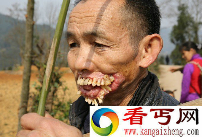 男子被狼舔过嘴后 长相异常恐怖