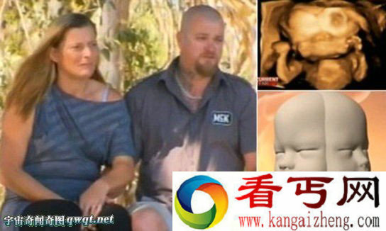 盘点世界各地让人心惊肉跳的怪胎 夫妇怀"双脸娃"