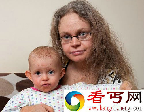 皮肤如纸般的脆弱 缺少蛋白质脱皮量是正常人的14倍