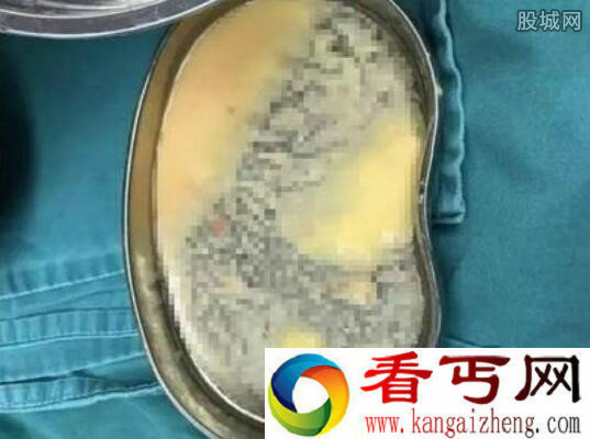 女子胸中取出玉米粥 竟是隆胸惹的祸