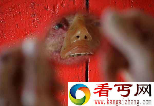 巴西一家惊悚变脸 皮肤一见太阳就开始融化