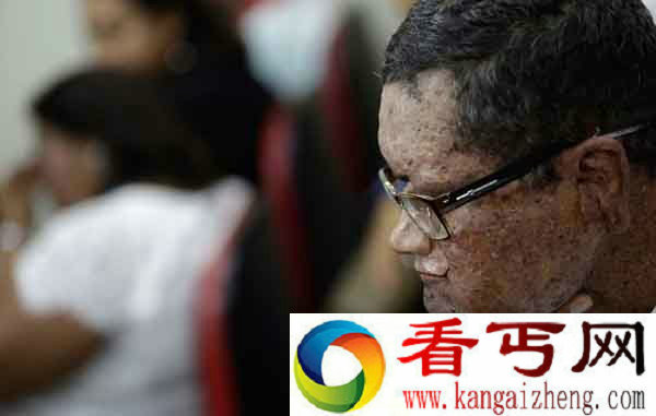 巴西一家惊悚变脸 皮肤一见太阳就开始融化