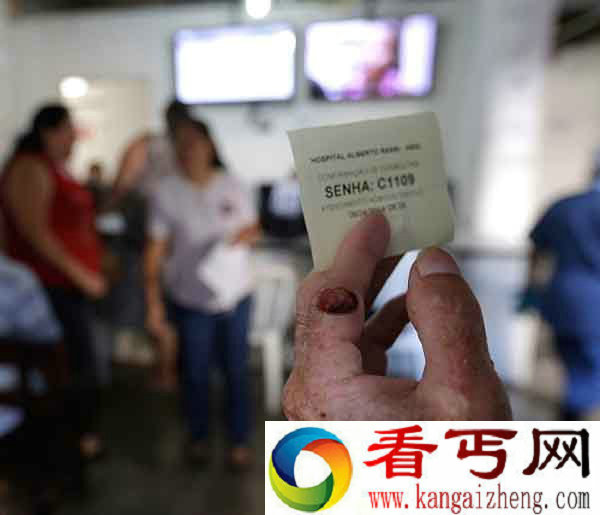 巴西一家惊悚变脸 皮肤一见太阳就开始融化