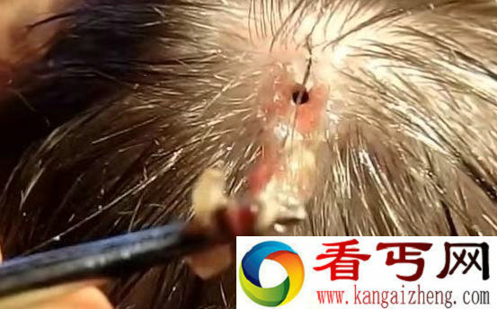 可怕!美国男子旅游归来头部留洞 罪魁祸首竟是马蝇