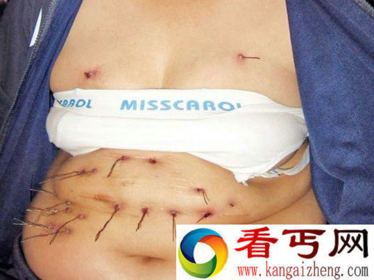 恐怖印尼女子皮肤不长毛发长金属丝