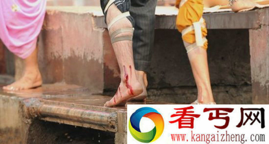 残忍且血腥印度奇怪的“放血”疗法