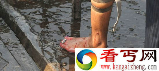 残忍且血腥印度奇怪的“放血”疗法