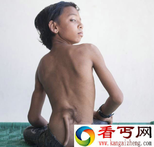 [图文]印度一少年长7英寸尾巴而被奉为神