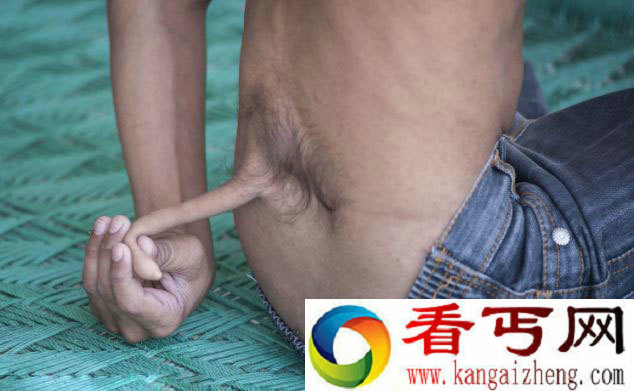[图文]印度一少年长7英寸尾巴而被奉为神