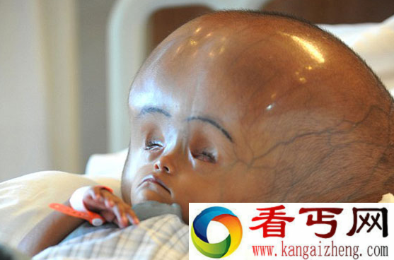 印度三岁女孩患脑积水 头比正常小孩大三倍