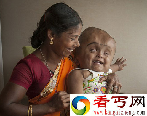 印度三岁女孩患脑积水 头比正常小孩大三倍