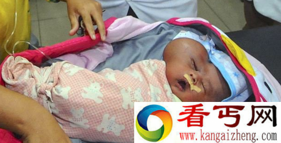 印度尼西亚男婴左脸长巨大肿瘤致脑部呈“心形”