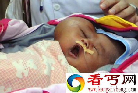 印度尼西亚男婴左脸长巨大肿瘤致脑部呈“心形”