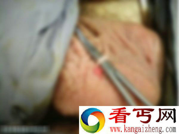 实拍男性结扎绝育手术全过程(有图慎入)