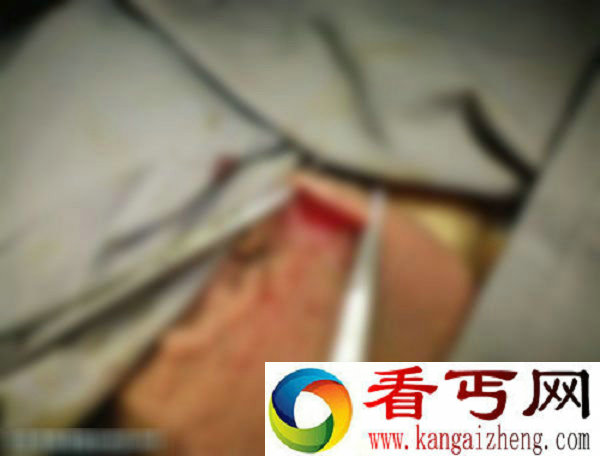 实拍男性结扎绝育手术全过程(有图慎入)