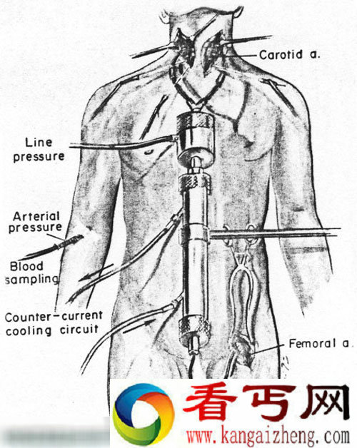 组图人类头部移植手术如何进行(组图)
