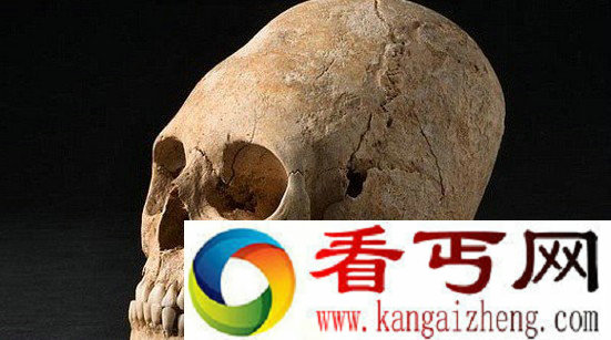 法国发现一个严重畸形的古代妇女头骨 可能是一名贵族.