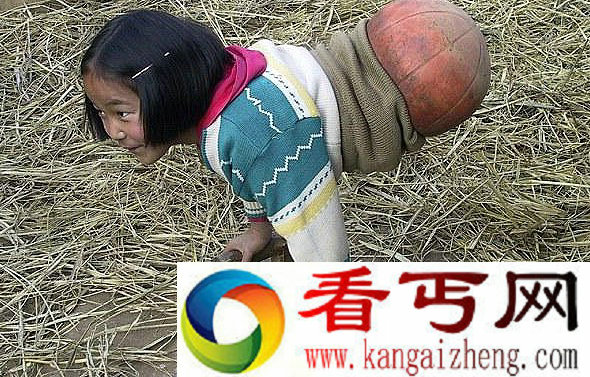 人生缺憾又完美 无腿女孩靠篮球走路却屡夺游泳冠军