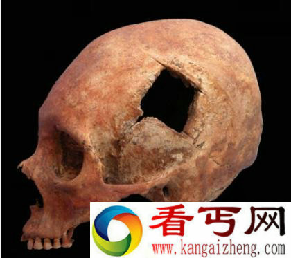 五千年前的印加开颅手术之谜 这是怎么做到的？