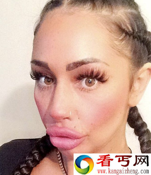 英国女子把嘴唇整成香肠嘴 结果悲剧了