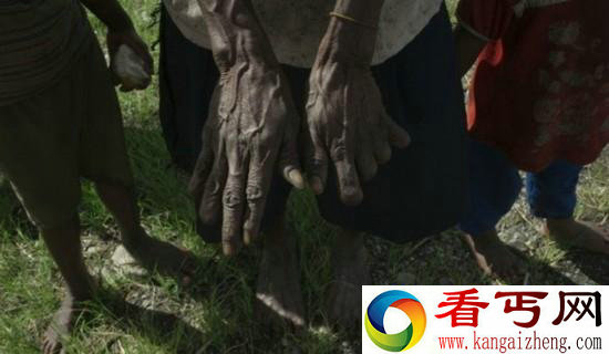 印尼断指习俗死去一个家属就要断指以示哀悼