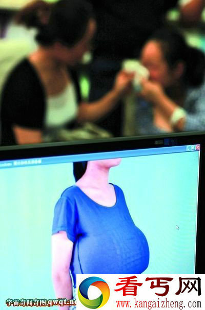 13岁女学生发育异常乳房大如篮球重量是常人20倍
