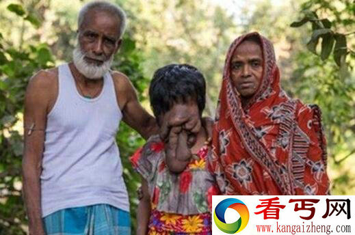 印度女子整脸长满肿瘤 连五官都不见了