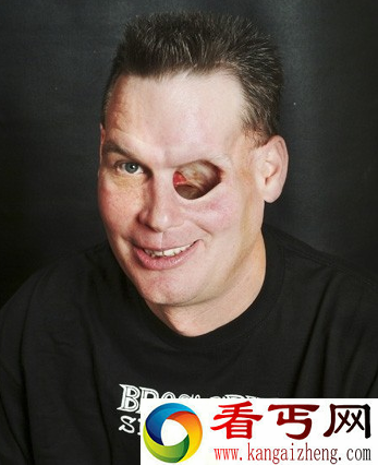 美国男子竟然用左眼的窟窿喝酒