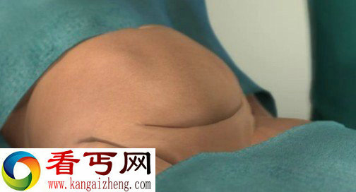 全过程实拍 快来看看剖腹产过程究竟是怎样的？