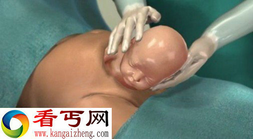 全过程实拍 快来看看剖腹产过程究竟是怎样的？
