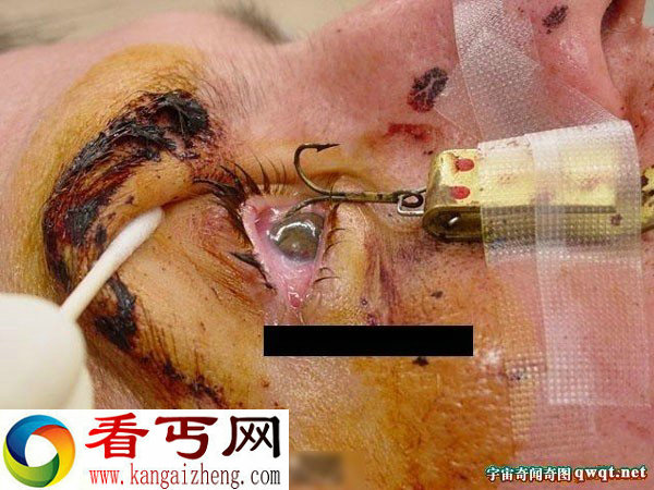 钓鱼发生惊恐一幕鱼钩差点把眼珠子勾出来