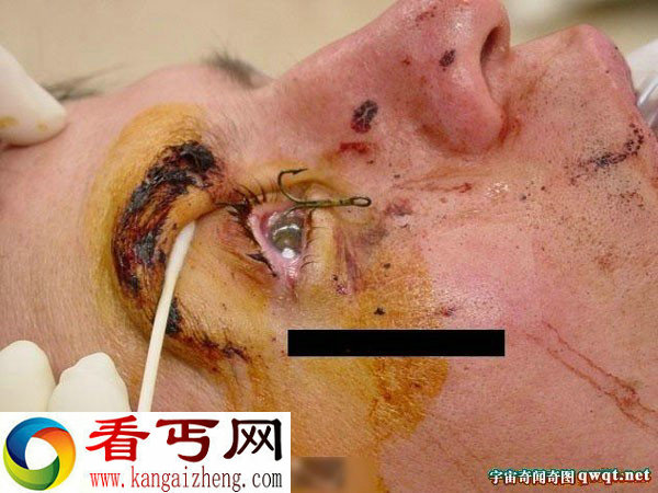 钓鱼发生惊恐一幕鱼钩差点把眼珠子勾出来