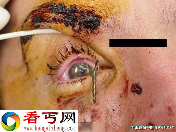 钓鱼发生惊恐一幕鱼钩差点把眼珠子勾出来