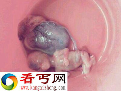 血腥，慎入! 实拍堕胎取出小生命的全过程