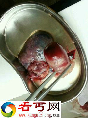 血腥，慎入! 实拍堕胎取出小生命的全过程
