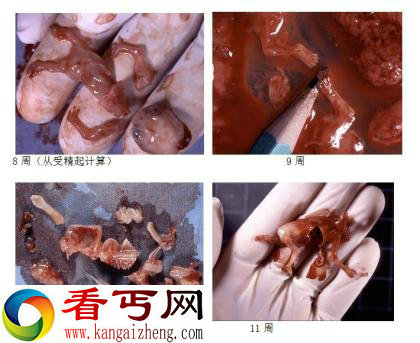 血腥，慎入! 实拍堕胎取出小生命的全过程