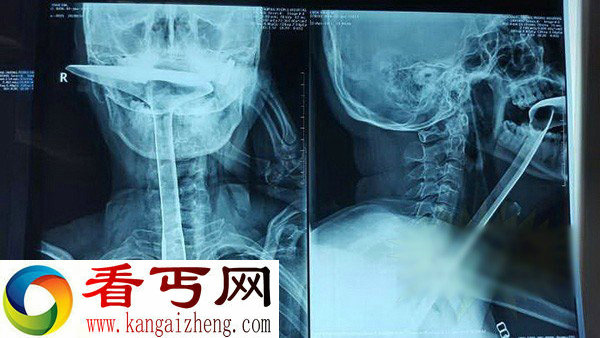 东莞女子将30厘米长锅铲插入食道 怀疑是否精神异常？
