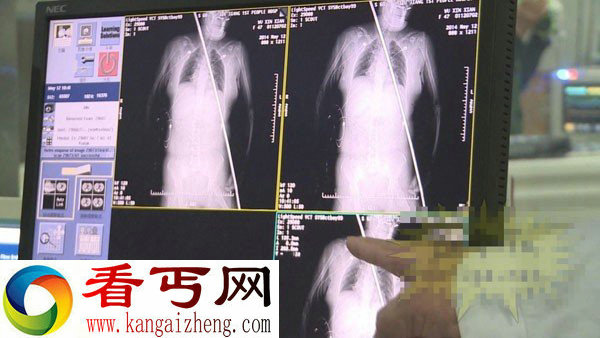 女工失足高空坠落 被钢筋穿身而过(抢