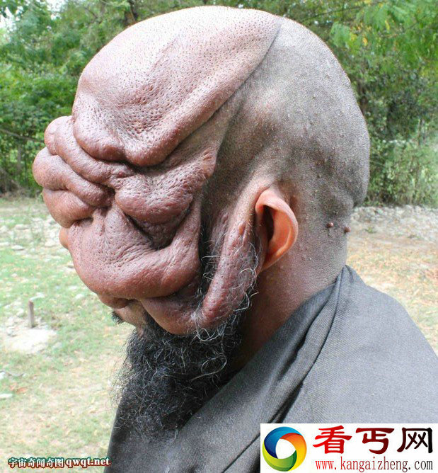 悲惨！印度男子脸部长肿瘤导致双目失明