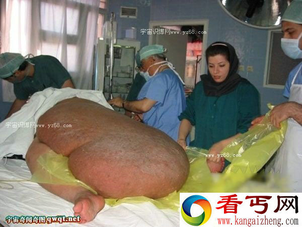 倒胃口！一肥婆切除数百斤肚腩后还能生存