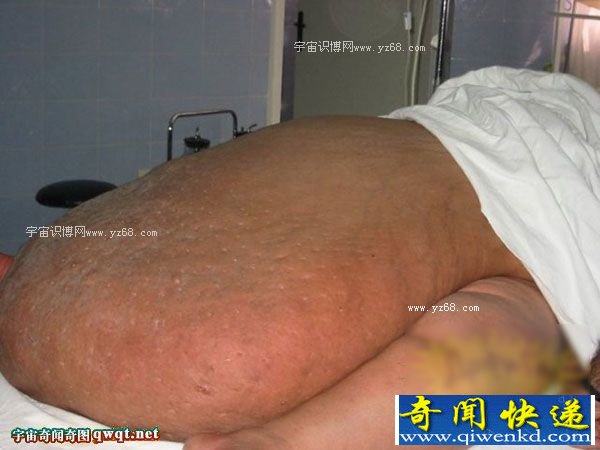 倒胃口！一肥婆切除数百斤肚腩后还能生存