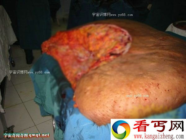 倒胃口！一肥婆切除数百斤肚腩后还能生存