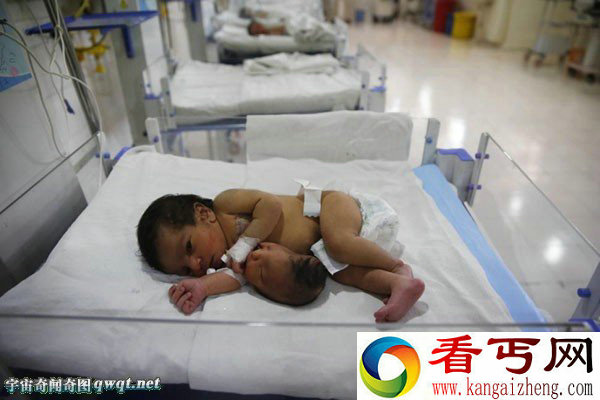 印度惊现双头女婴 肚子上长出一个头