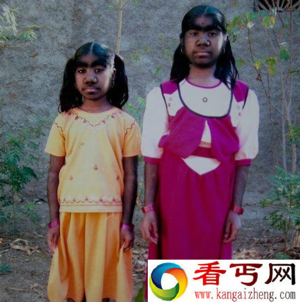 印度女子产下一名男婴 浑身是毛如同狼人