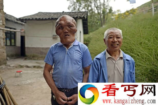 重庆男子患怪病面部增大 神似外星人