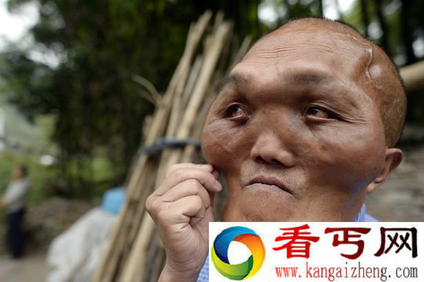重庆男子患怪病面部增大 神似外星人